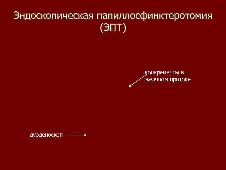 Эндоскопическая папиллосфинктеротомия (ЭПТ) конкременты в желчном протоке дуоденоскоп 