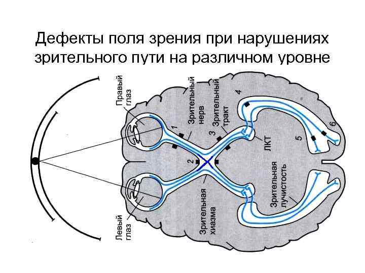 Дефекты поля зрения при нарушениях зрительного пути на различном уровне 