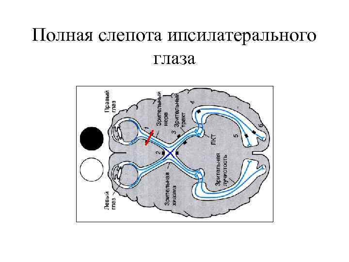 Полная слепота ипсилатерального глаза 