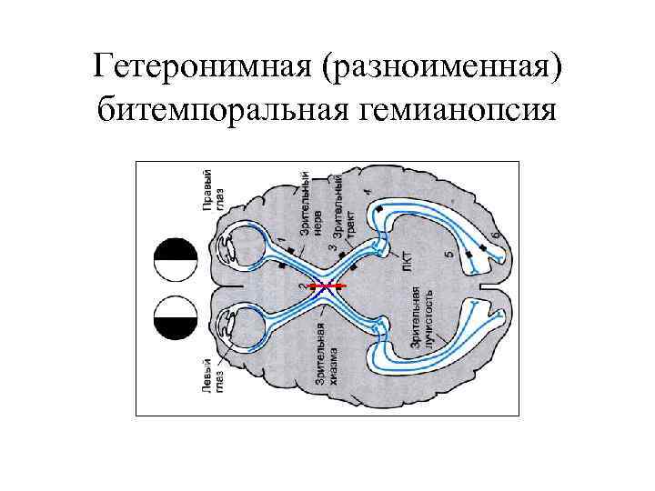 Гетеронимная (разноименная) битемпоральная гемианопсия 