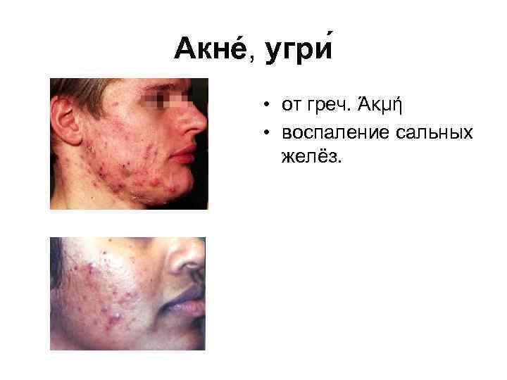 Акнé, угри • от греч. Άκμή • воспаление сальных желёз. 