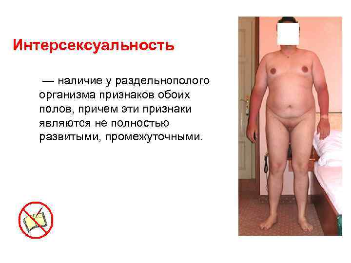 Интерсексуальность — наличие у раздельнополого организма признаков обоих полов, причем эти признаки являются не