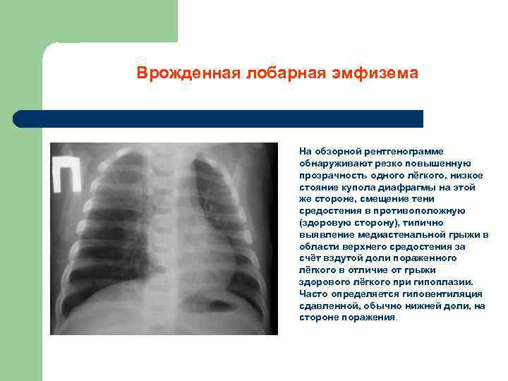 Врожденная лобарная эмфизема На обзорной рентгенограмме обнаруживают резко повышенную прозрачность одного лёгкого, низкое стояние