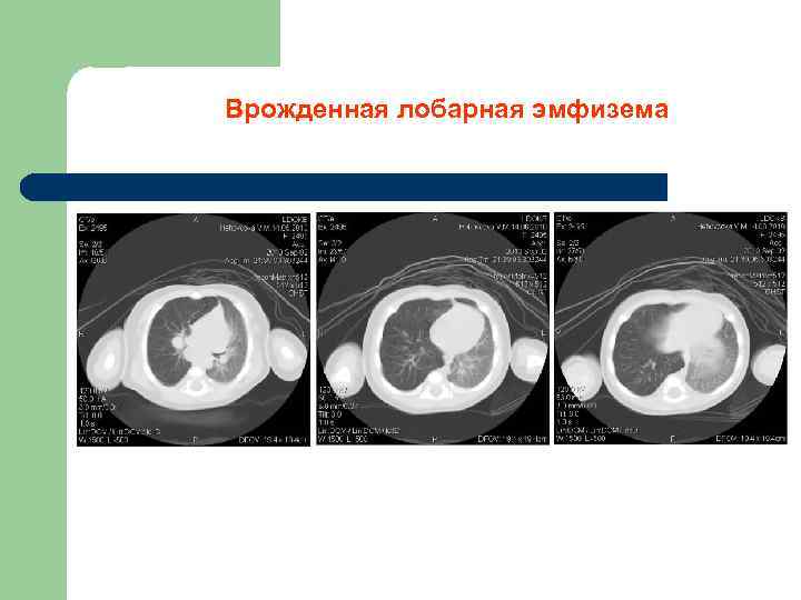 Врожденная лобарная эмфизема 