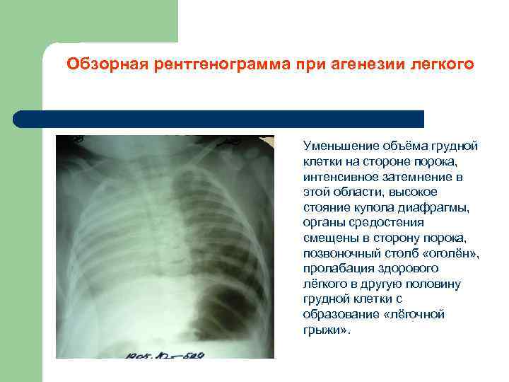 Обзорная рентгенограмма при агенезии легкого Уменьшение объёма грудной клетки на стороне порока, интенсивное затемнение