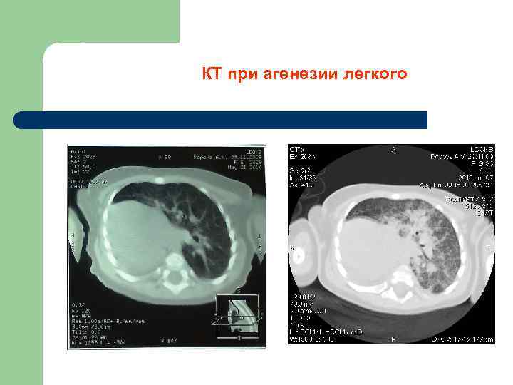 КТ при агенезии легкого 