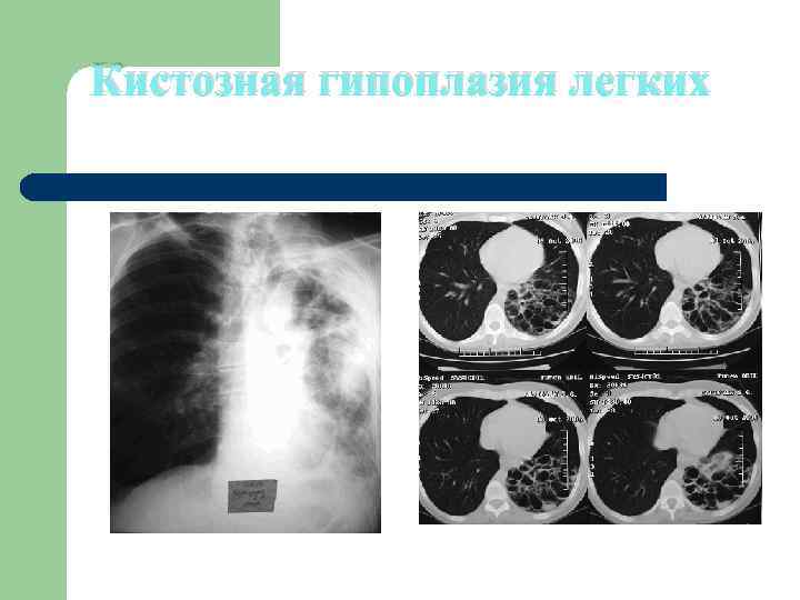 Кистозная гипоплазия легких 