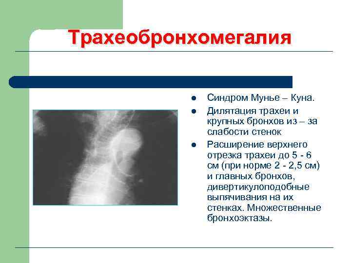 Трахеобронхомегалия l l l Синдром Мунье – Куна. Дилятация трахеи и крупных бронхов из