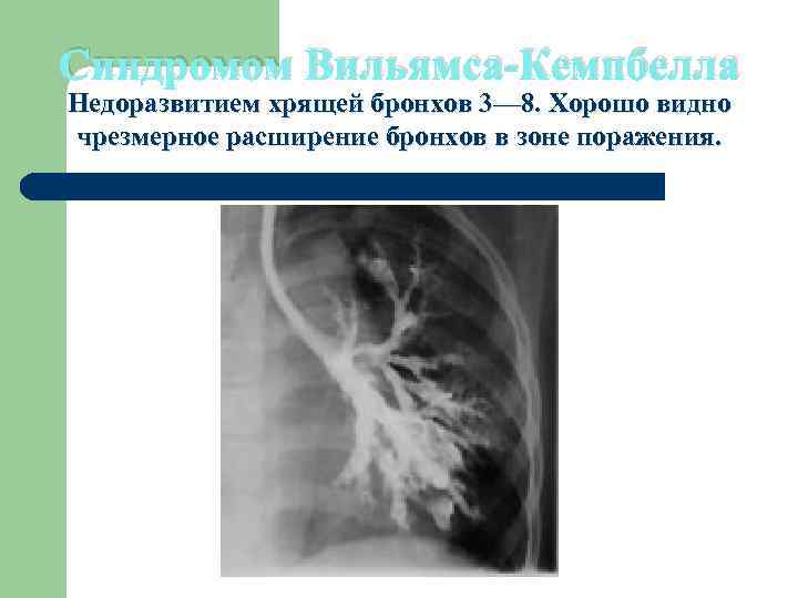 Синдромом Вильямса-Кемпбелла Недоразвитием хрящей бронхов 3— 8. Хорошо видно чрезмерное расширение бронхов в зоне