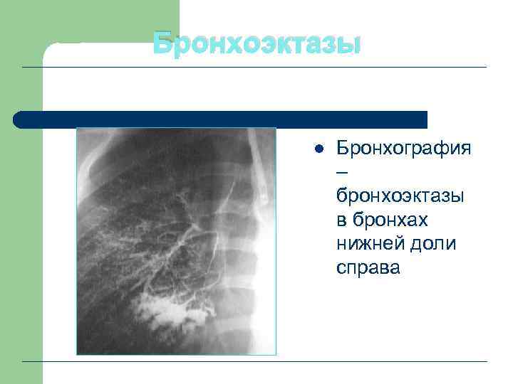 Бронхоэктазы l Бронхография – бронхоэктазы в бронхах нижней доли справа 