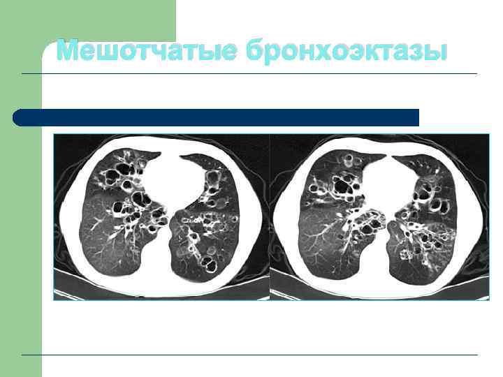 Мешотчатые бронхоэктазы 