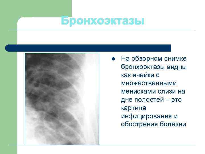 Бронхоэктазы l На обзорном снимке бронхоэктазы видны как ячейки с множественными менисками слизи на