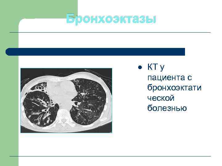 Бронхоэктазы l КТ у пациента с бронхоэктати ческой болезнью 