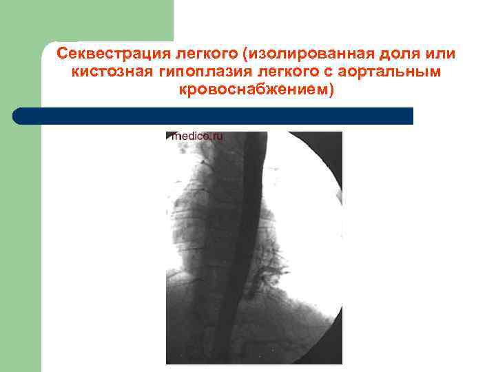 Секвестрация легкого (изолированная доля или кистозная гипоплазия легкого с аортальным кровоснабжением) 