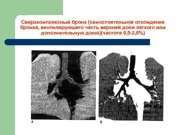Сверхкомплексный бронх (самостоятельное отхождение бронха, вентилирующего часть верхней доли легкого или дополнительную долю)(частота 0,