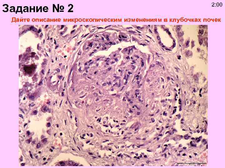 Задание № 2 2: 00 Дайте описание микроскопическим изменениям в клубочках почек 