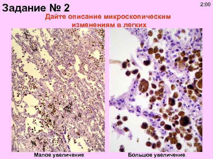 2: 00 Задание № 2 Дайте описание микроскопическим изменениям в легких Малое увеличение Большое