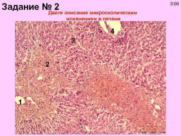 3: 00 Задание № 2 Дайте описание микроскопическим изменениям в печени 4 3 2