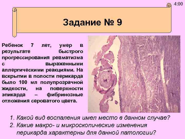 4: 00 Задание № 9 Ребенок 7 лет, умер в результате быстрого прогрессирования ревматизма