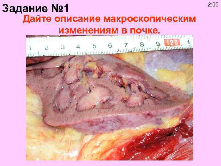 Задание № 1 Дайте описание макроскопическим изменениям в почке. 2: 00 