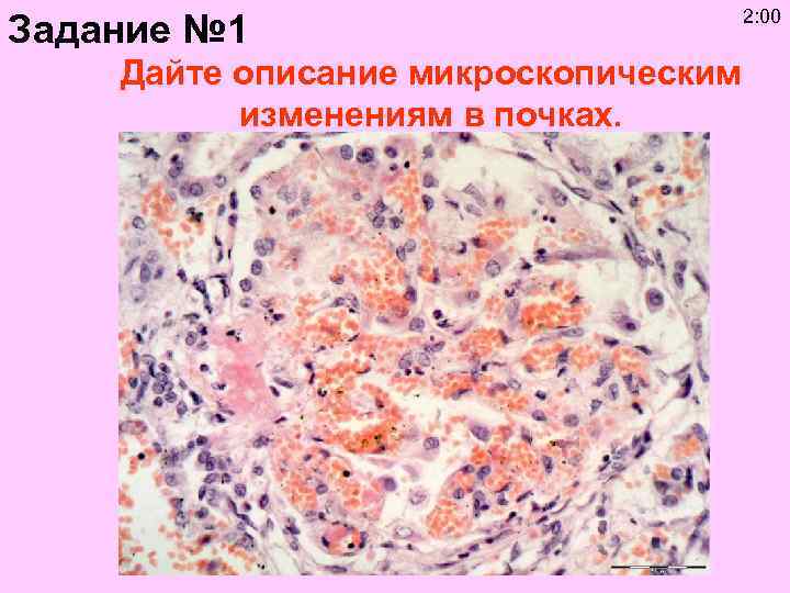 Задание № 1 Дайте описание микроскопическим изменениям в почках. 2: 00 