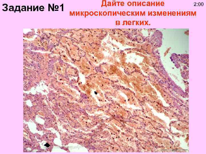 Задание № 1 2: 00 Дайте описание микроскопическим изменениям в легких. 