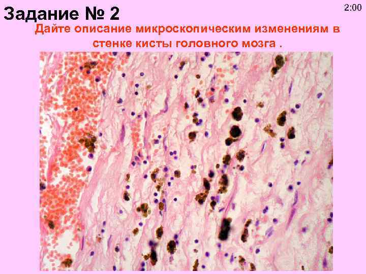 Задание № 2 Дайте описание микроскопическим изменениям в стенке кисты головного мозга. 2: 00