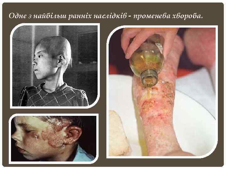 Одне з найбільш ранніх наслідків - променева хвороба. 