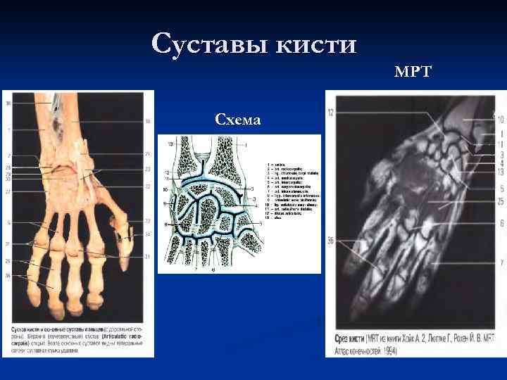 Суставы кисти Схема МРТ 