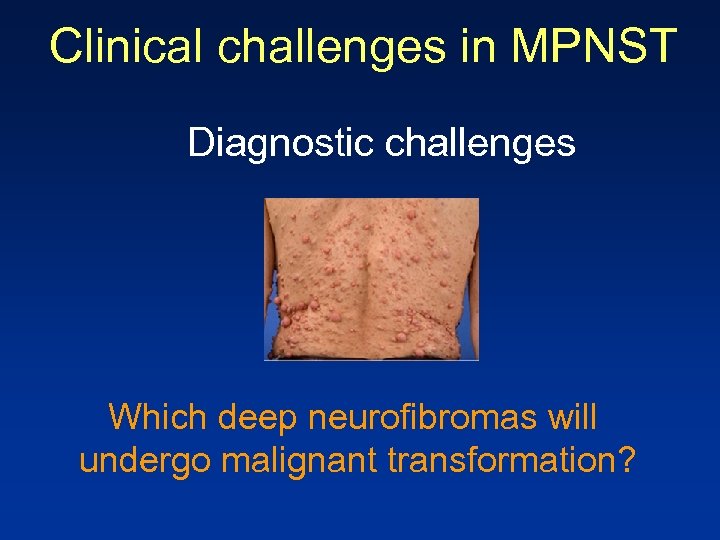 Clinical challenges in MPNST Diagnostic challenges Which deep neurofibromas will undergo malignant transformation? 