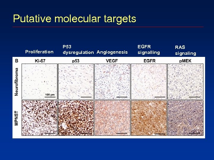 Putative molecular targets Proliferation P 53 dysregulation Angiogenesis EGFR signalling RAS signaling 