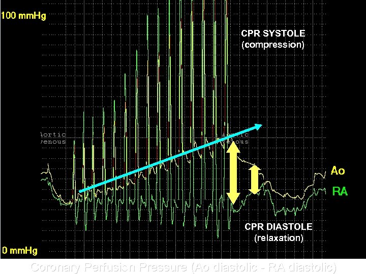 CPR SYSTOLE (compression) CPR DIASTOLE (relaxation) Coronary Perfusion Pressure (Ao diastolic - RA diastolic)