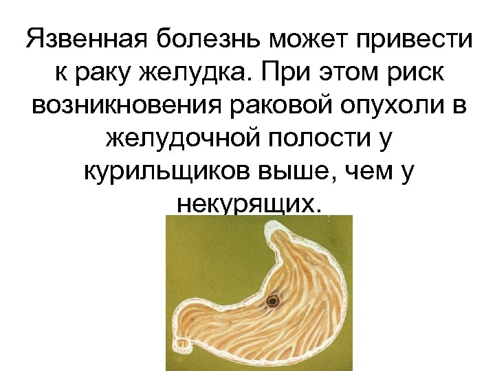 Язвенная болезнь может привести к раку желудка. При этом риск возникновения раковой опухоли в