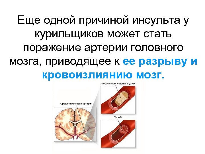 Еще одной причиной инсульта у курильщиков может стать поражение артерии головного мозга, приводящее к