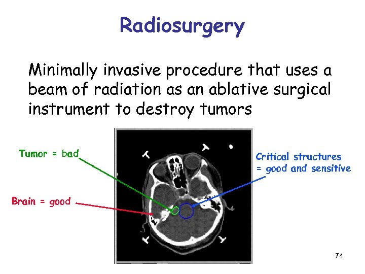 Radiosurgery Minimally invasive procedure that uses a beam of radiation as an ablative surgical