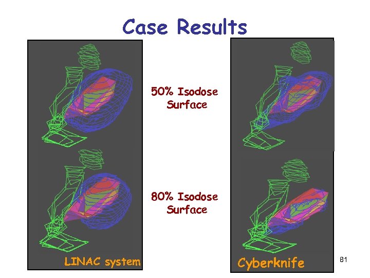 Case Results 50% Isodose Surface 80% Isodose Surface LINAC system Cyberknife 81 