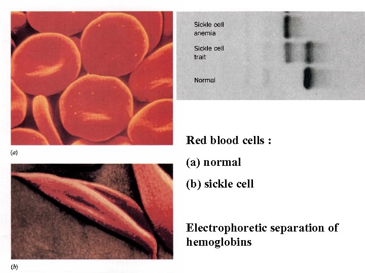 Red blood cells : (a) normal (b) sickle cell Electrophoretic separation of hemoglobins 