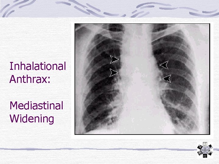 Inhalational Anthrax: Mediastinal Widening 