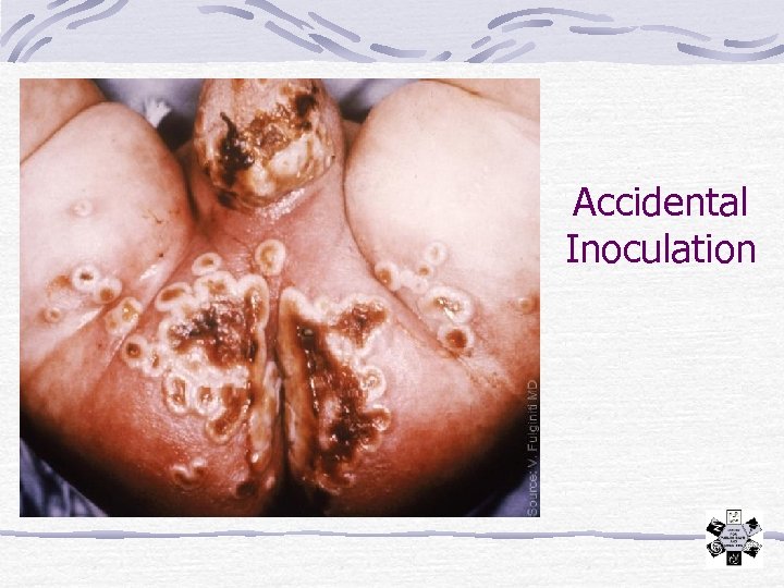 Accidental Inoculation 