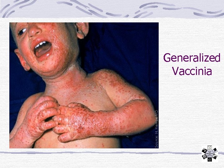 Generalized Vaccinia 