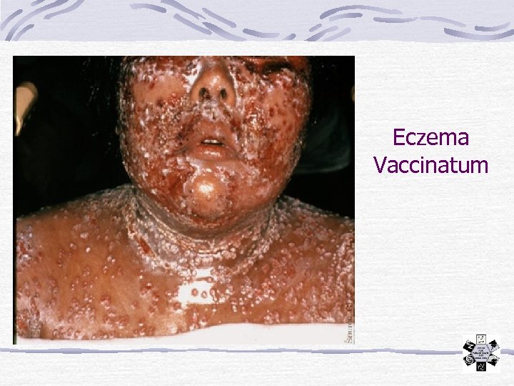 Eczema Vaccinatum 