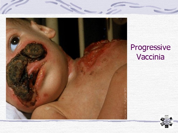 Progressive Vaccinia 