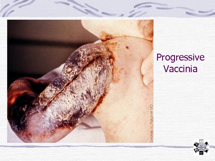 Progressive Vaccinia 