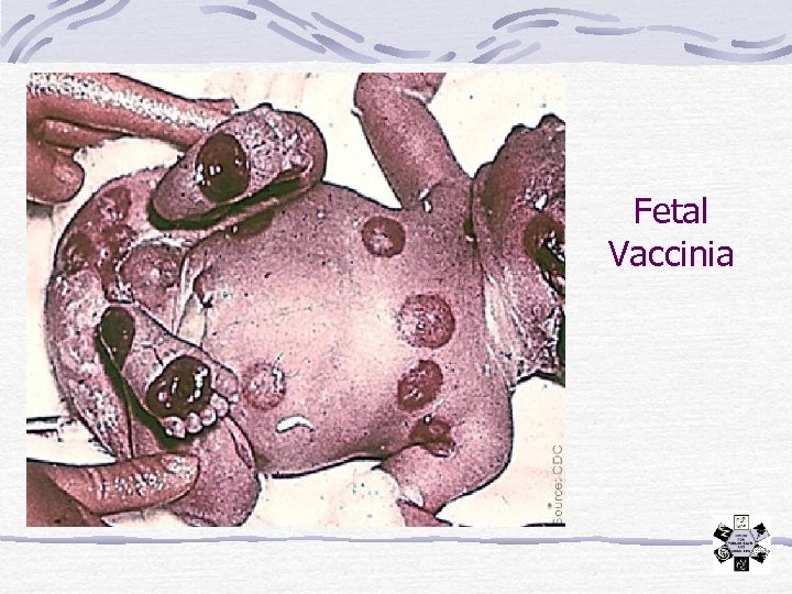Fetal Vaccinia 