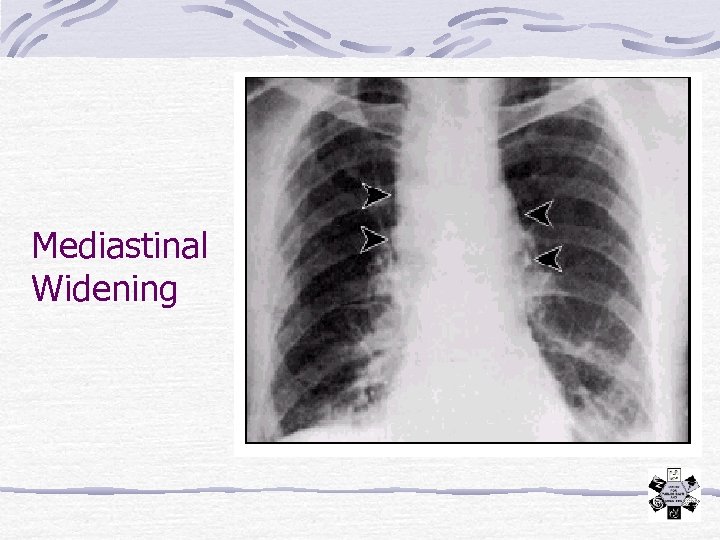 Mediastinal Widening 