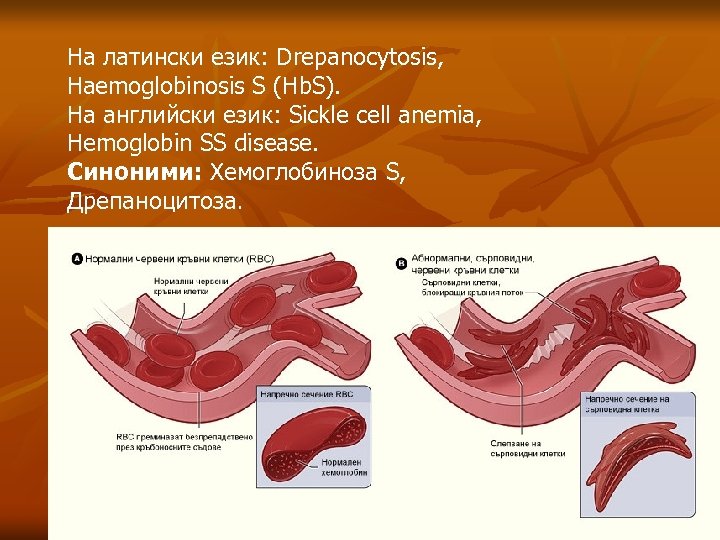 На латински език: Drepanocytosis, Haemoglobinosis S (Hb. S). На английски език: Sickle cell anemia,