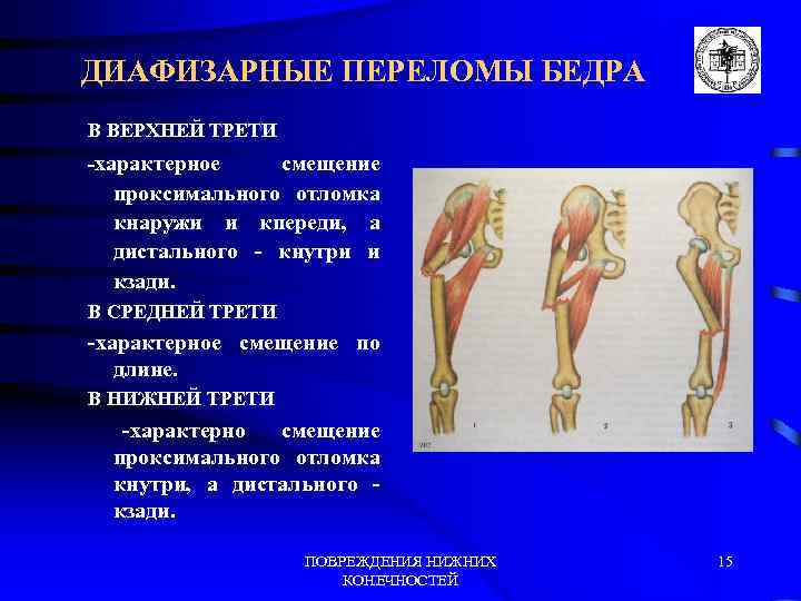 ДИАФИЗАРНЫЕ ПЕРЕЛОМЫ БЕДРА В ВЕРХНЕЙ ТРЕТИ -характерное смещение проксимального отломка кнаружи и кпереди, а