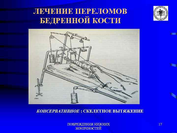 Схема скелетного вытяжения при переломах бедренной кости