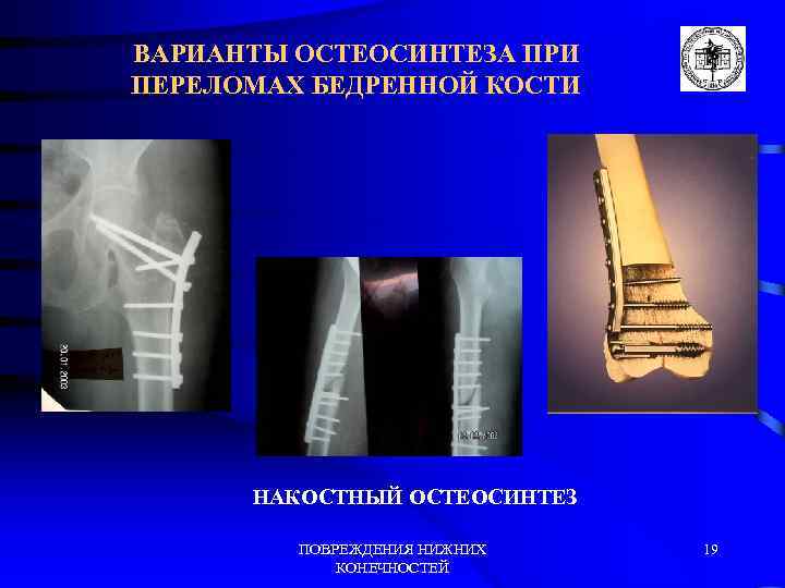 ВАРИАНТЫ ОСТЕОСИНТЕЗА ПРИ ПЕРЕЛОМАХ БЕДРЕННОЙ КОСТИ НАКОСТНЫЙ ОСТЕОСИНТЕЗ ПОВРЕЖДЕНИЯ НИЖНИХ КОНЕЧНОСТЕЙ 19 