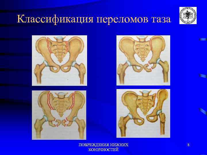 Классификация переломов таза ПОВРЕЖДЕНИЯ НИЖНИХ КОНЕЧНОСТЕЙ 8 